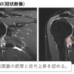 凍結肩/肩関節周囲炎のMRI画像所見のポイント！